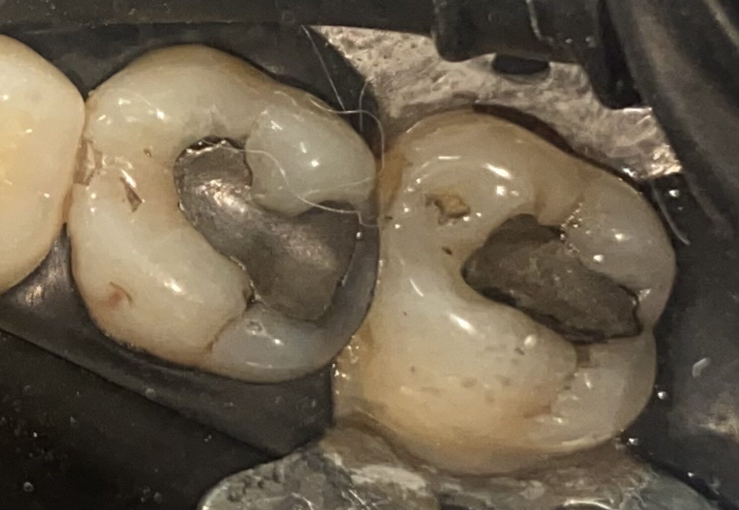 cambio de amalgama por composite odontologia estetica