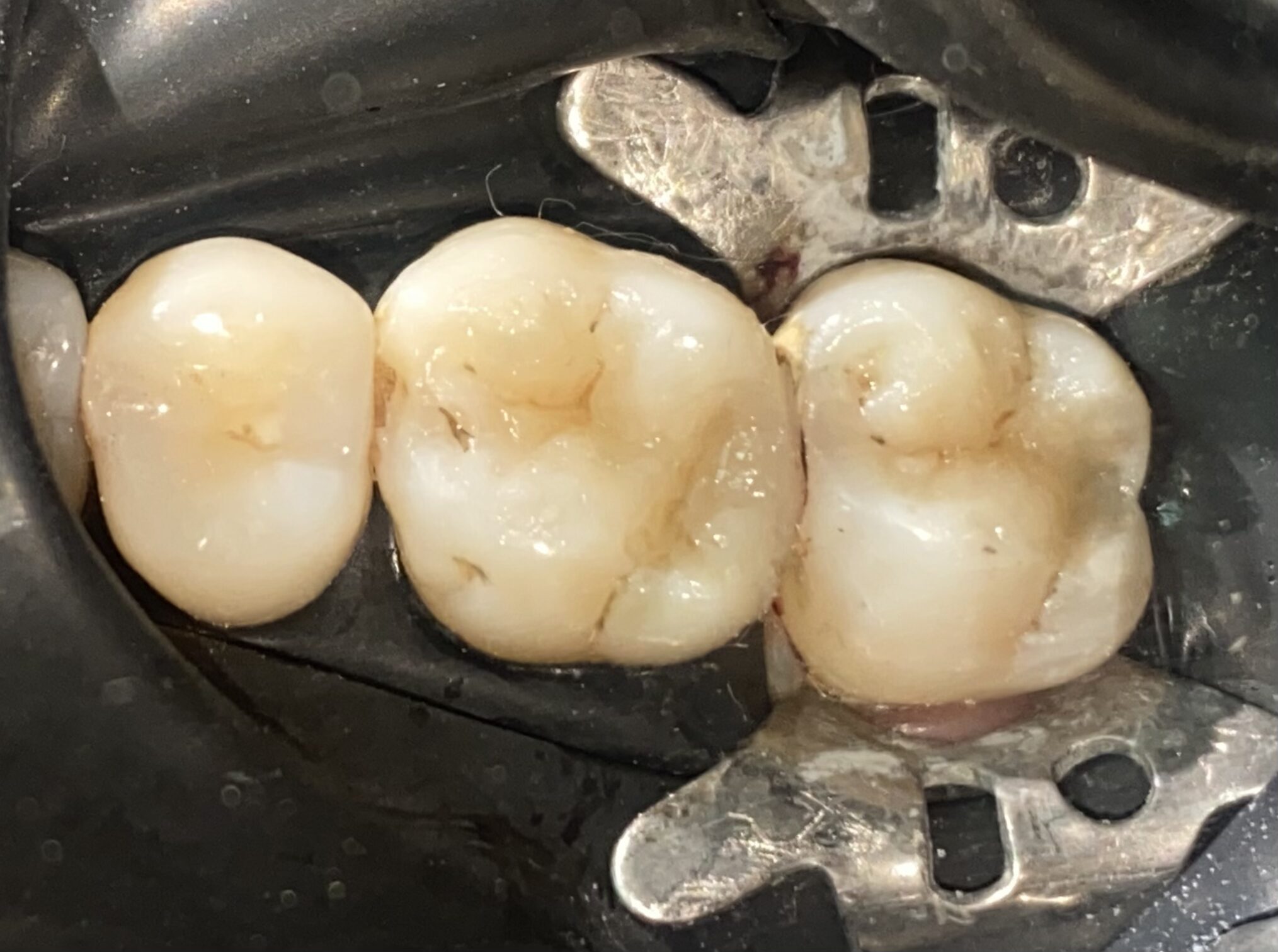 cambio de amalgama por composite odontologia estetica