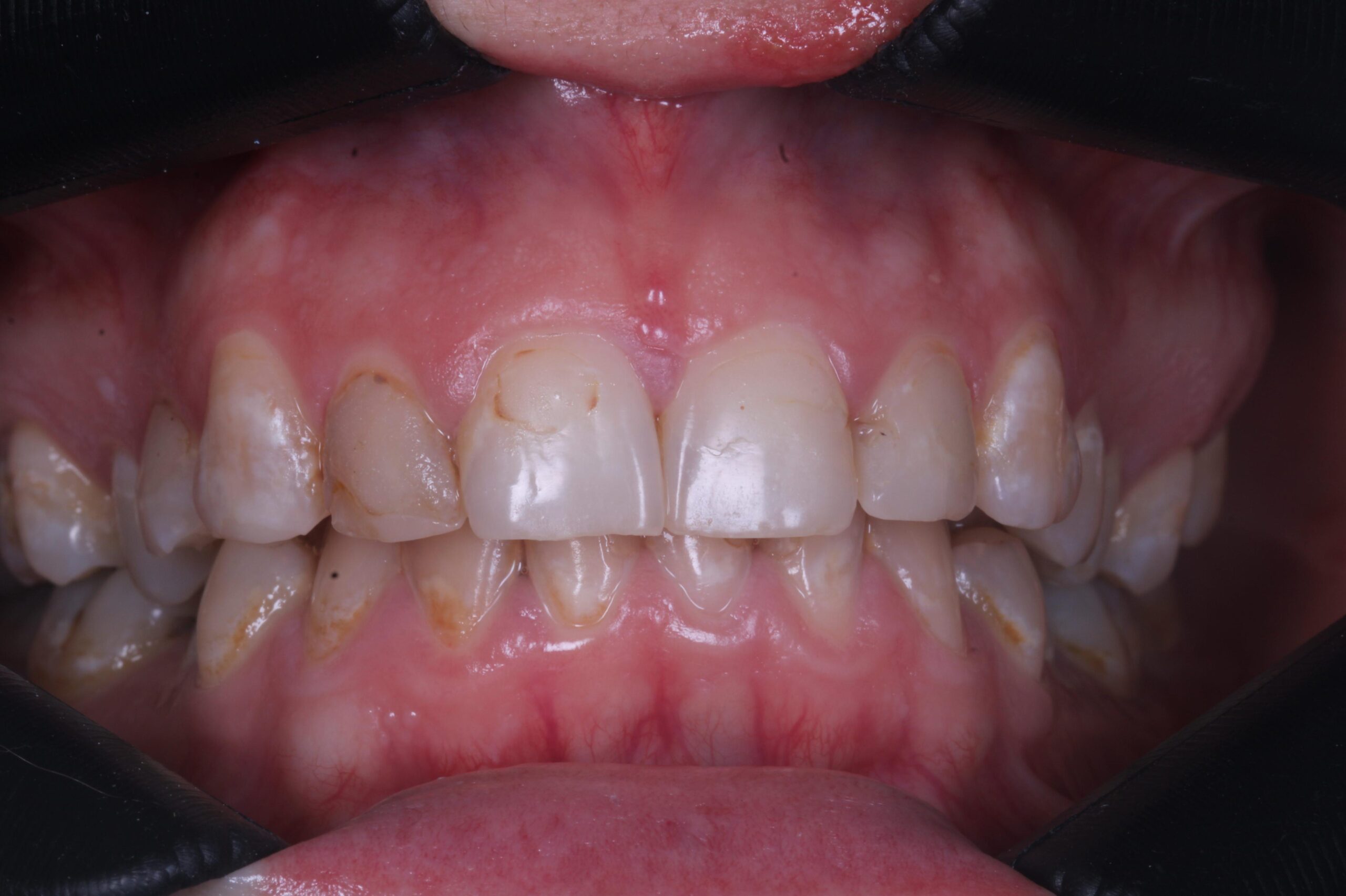 carillas de resina antes doctora darchuk